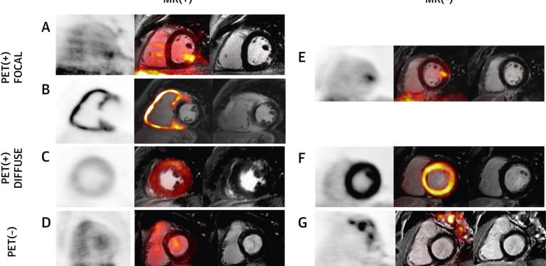 Hybrid Magnetic Resonance Positron Emission Tomography Is Associated With Cardiac-Related Outcomes in Cardiac Sarcoidosis.